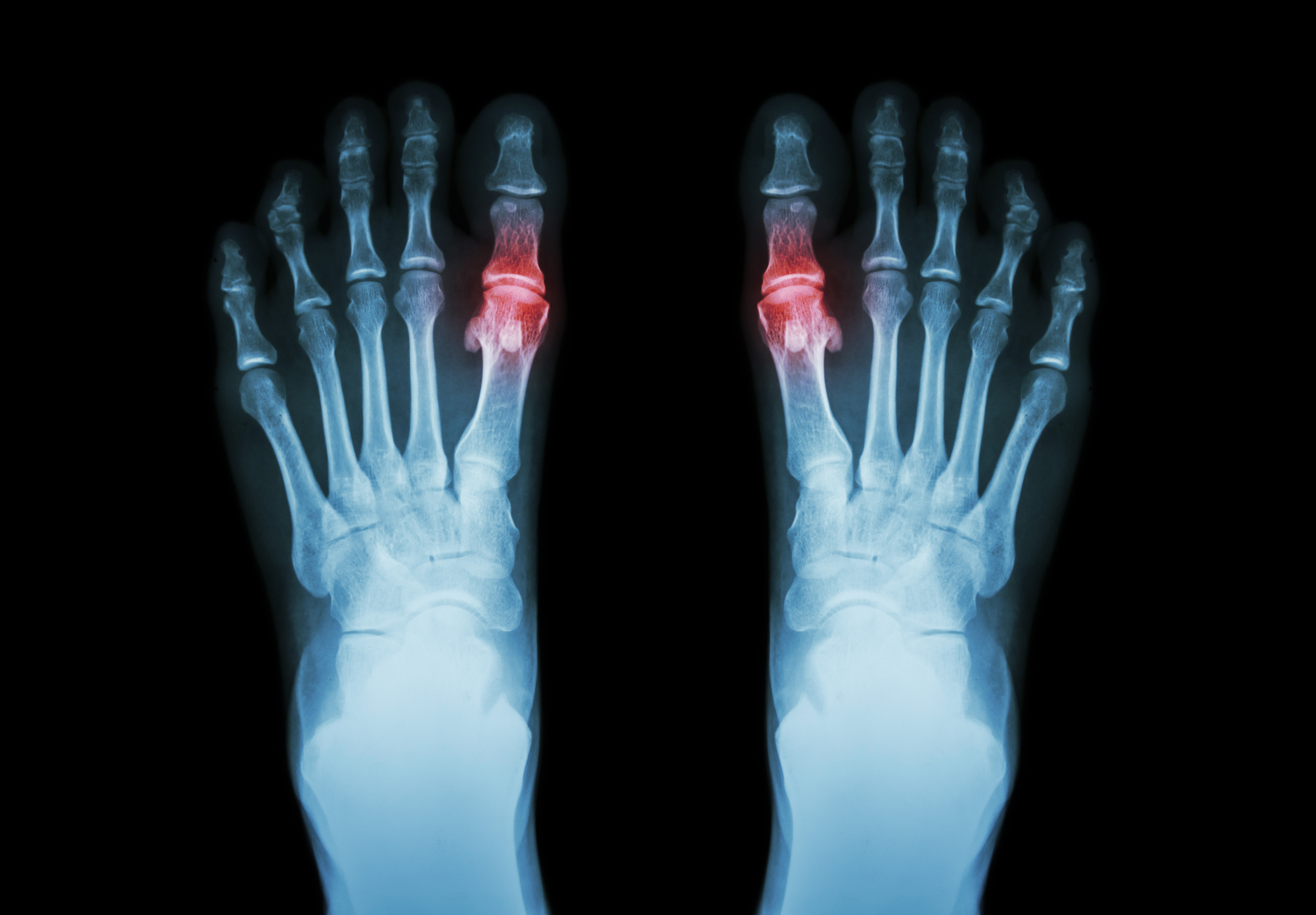gout-rheumatoid-arthritis-film-x-ray-both-foot-arthritis.jpg