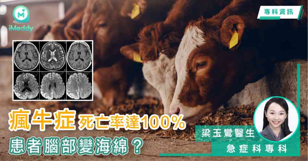 梁玉鸞醫生 — 瘋牛症死亡率達100％ 患者腦部變海綿？