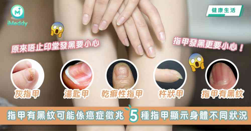 原來唔止印堂發黑要小心 指甲發黑更要小心 指甲有黑紋可能係癌症徵兆 5種指甲顯示身體不同狀況